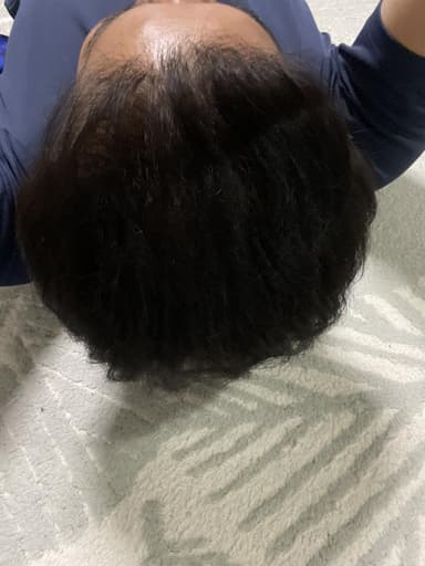 SAP-ミノキシジル10mg 【1箱30錠】 レビュー投稿画像 サムネイル