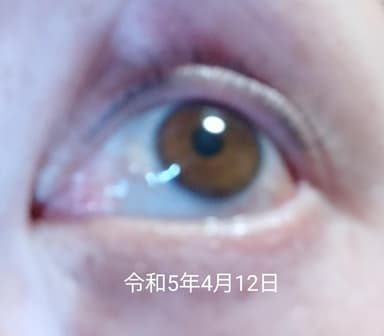 ルミガン点眼液0.03％ + アプリケータ レビュー投稿画像 サムネイル