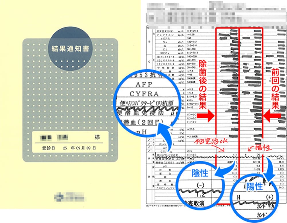 結果は「陰性」、ピロリ菌除菌薬は効果がありました!