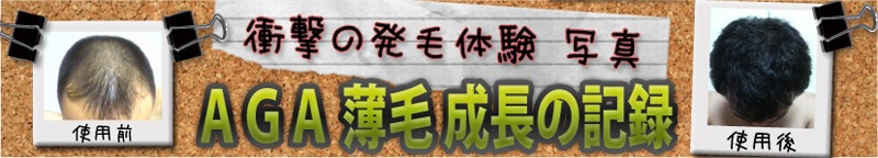 -使用前-衝撃の発毛体験写真・AGA薄毛成長の記録-使用後-